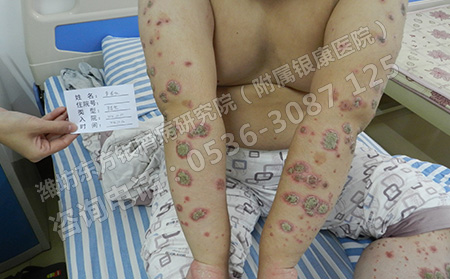 牛皮癣这种慢性病怎么能更快治好