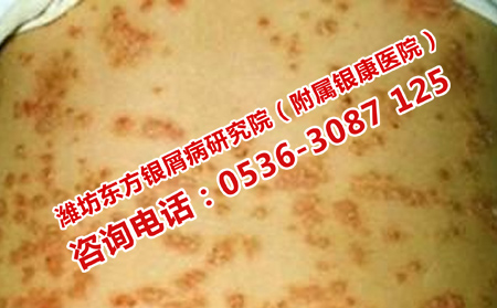 牛皮癣患者的心理疏导