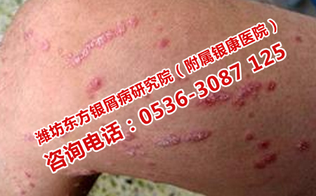 得了银屑病有什么后果