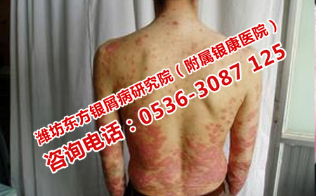 天气炎热怎样预防牛皮癣