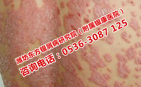 在饮食方面怎么控制牛皮癣