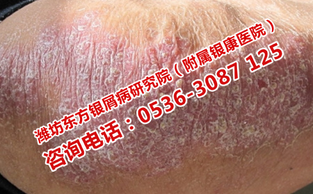 阶段性的牛皮癣出现是为什么