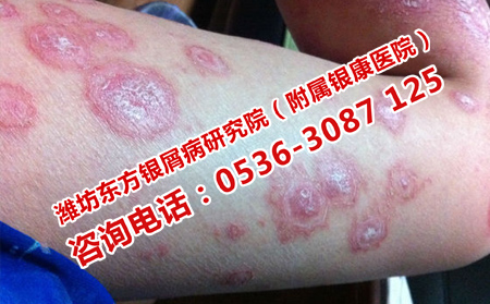 如何治疗牛皮癣好的快