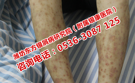 预防牛皮癣秋季复发