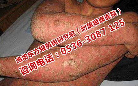 潍坊哪家医院有效治好牛皮癣