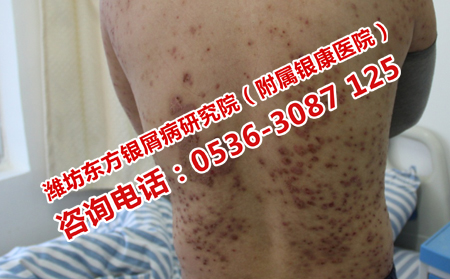 银屑病护理意识