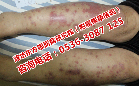 锻炼身体对关节型银屑病的影响