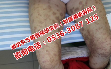 关节型银屑病如何护理呢