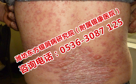 治疗银屑病的时候男性银屑病患者可以吸烟吗