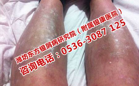 关节型银屑病如何治疗好