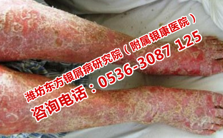 中医治疗关节型银屑病