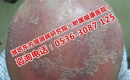如何预防遗传性银屑病