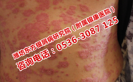 护理急性点滴型银屑病的办法