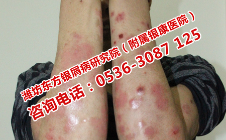 小面积银屑病的治疗