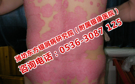 红皮型银屑病治疗时间是