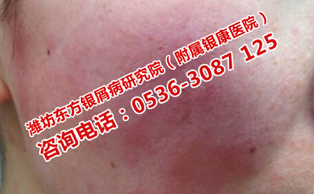 潍坊治儿童银屑病