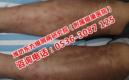 一些不良习惯导致银屑病的危害