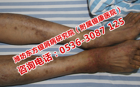 寿光治疗银屑病医生
