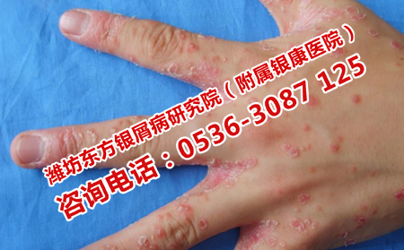 银屑病患者吸烟的危害