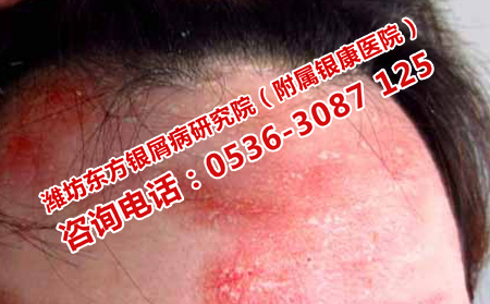 银屑病为何突然复发