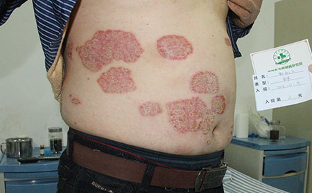 影响银屑病病情的四大诱因