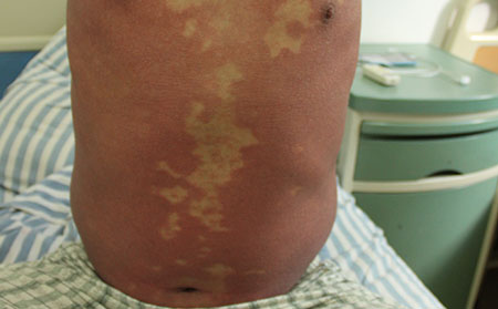 夏天银屑病能吃烧烤吗