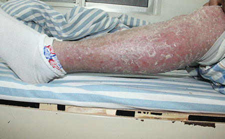 脓疱性银屑病治疗办法