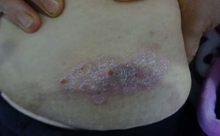 牛皮癣秋季预防