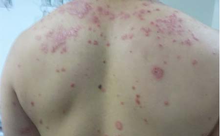 银屑病加重的症状