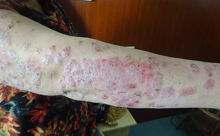 银屑病中医病因