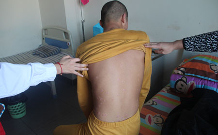 潍坊治儿童银屑病