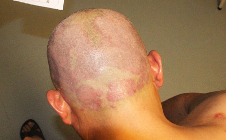 如何护理银屑病