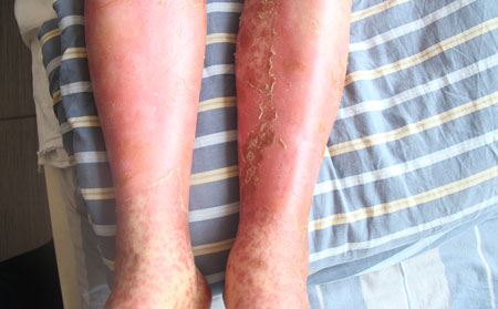 脓疱性银屑病的介绍