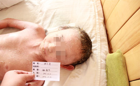 银屑病怎么治疗