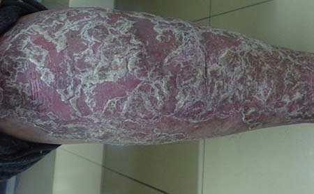 重症银屑病危害