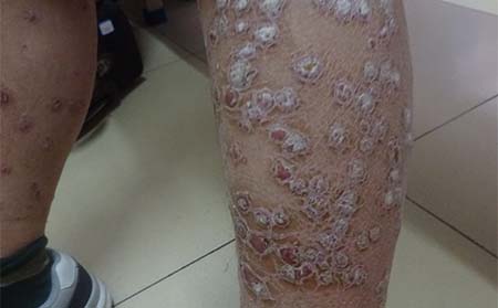 严重银屑病的症状和危害