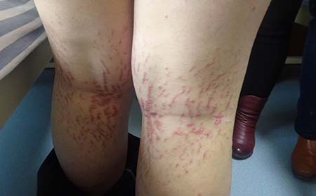儿童银屑病治疗注意问题