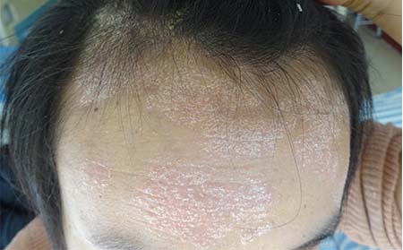 预防银屑病遗传的方法