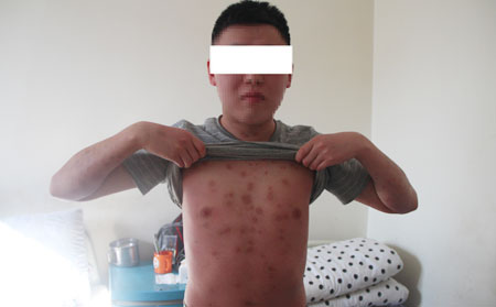 儿童银屑病治疗