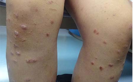 儿童银屑病的危害情况