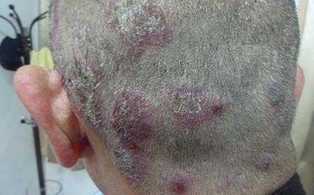 头部银屑病怎么护理