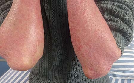 生活中促使牛皮癣发病原因