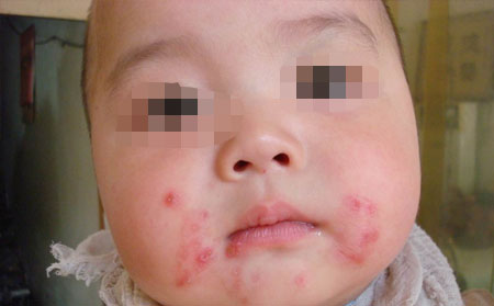 银屑病的护理方法