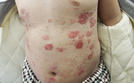 男性银屑病的护理