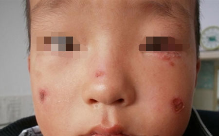 如何对儿童银屑病患者进行心理疏导