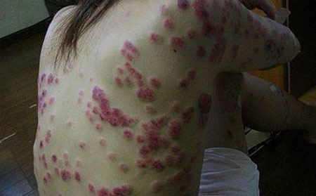如何护理重症银屑病