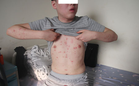 牛皮癣患者如何保持可以心情