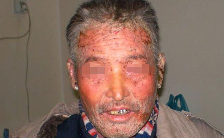 老年人得银屑病的原因