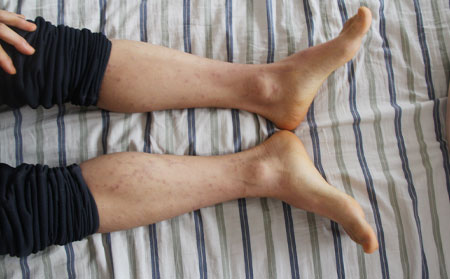 什么是非典型牛皮癣症状