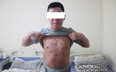 牛皮癣消退期会有什么表现